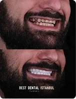 A man’s teeth before and after treatment